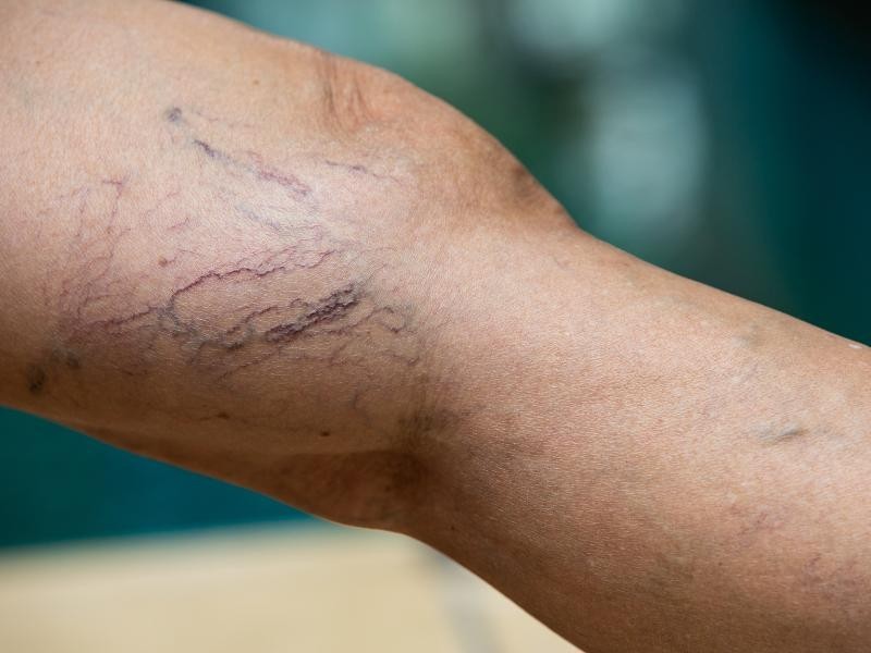 Secagem De Varizes Com Laser