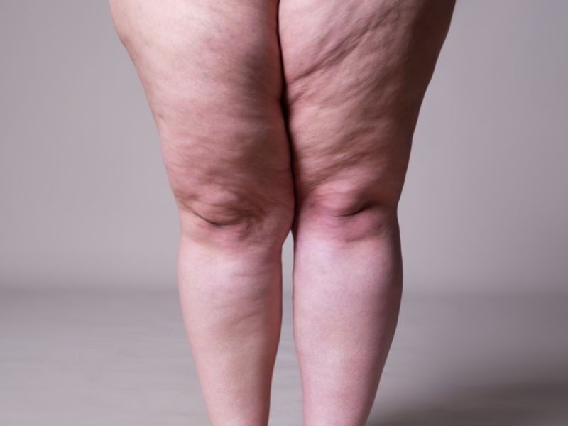 Lipedema